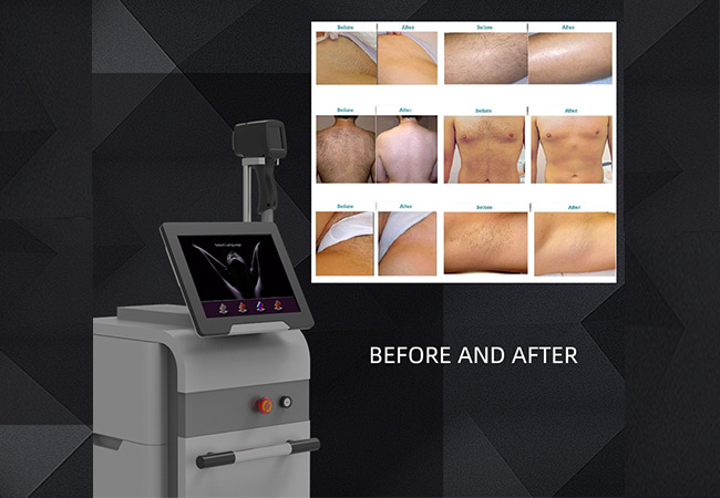 Applications of Laser Hair Removal Machines